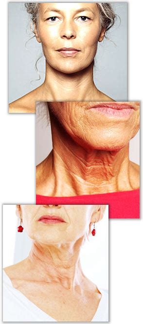 halsrynkor behandling