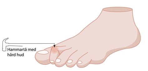 hammartår behandling