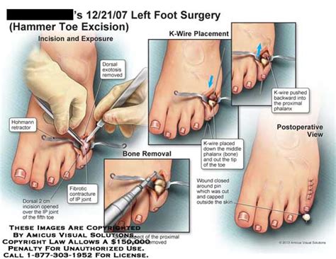 hammertoe surgery recover time Bone, Joint and Ligament …