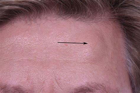 hard lump on forehead under skin - c-vine.com