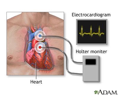 hartritme monitoring