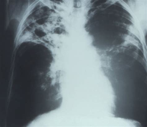 hasil rontgen tb paru aktif