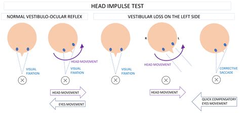Head Impulse Test Positive