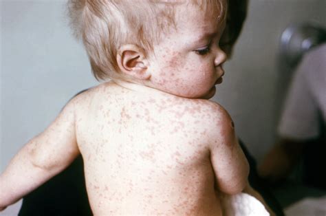 Health Ministry Urges Caution After Measles Outbreak Science Is All Around Us - Science Is All Around Us