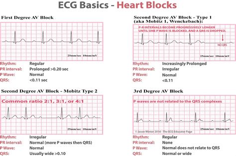 Heart Block Ecg