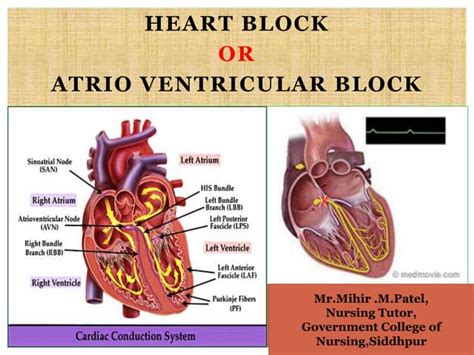 Heart Block Ppt