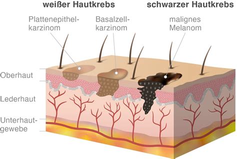 heller hautkrebs arten