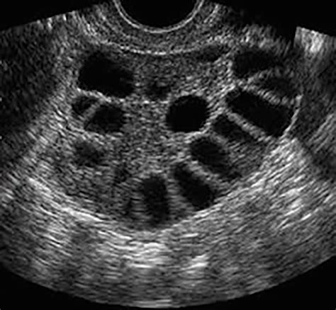 hematometra ultrasound findings in polycystic ovarian