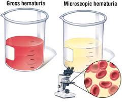 hematuria-4
