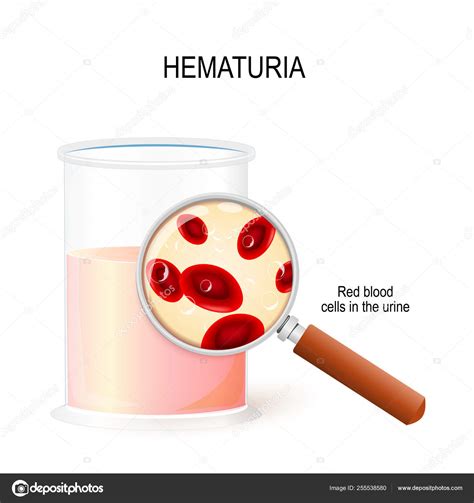 hematúria - sax alto