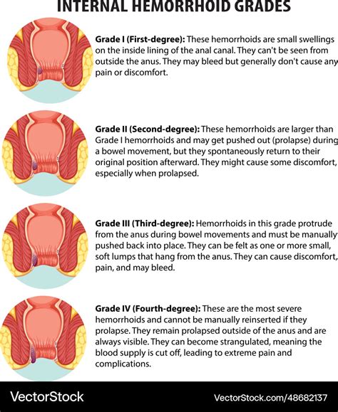 Hemorrhoid Size Chart