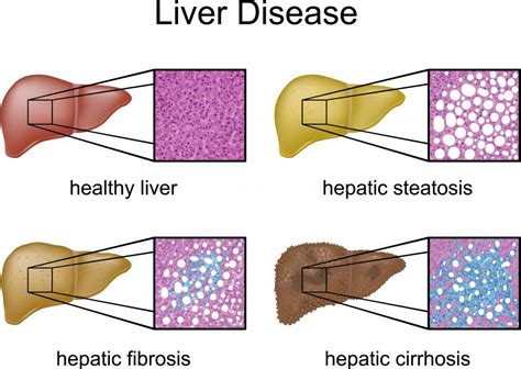 Hepatic Fibrosis