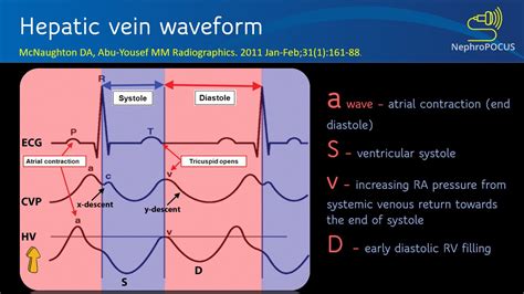Hepatic Vein Wave Form Vs Portal Ccein Wavefrom