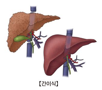 hepatitis 뜻 - 간염 질환백과 의료정보 건강정보 서울아산병원