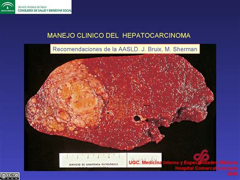 hepatocarcinoma