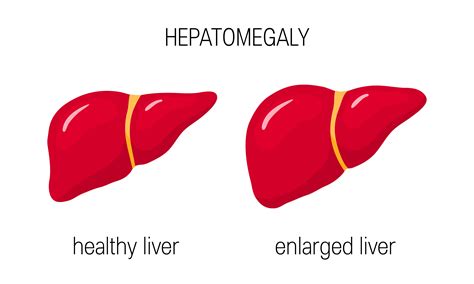 hepatomegalia