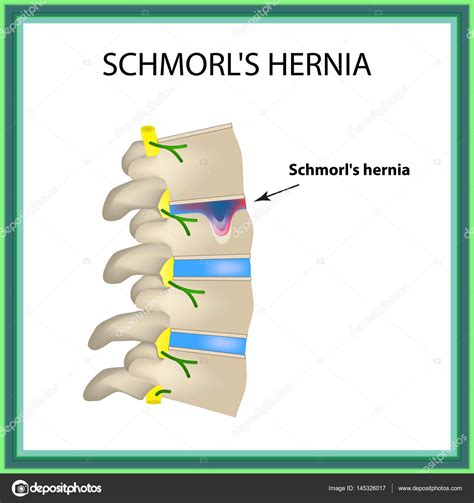 Hernia De Schmorl