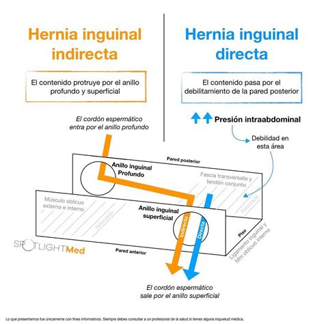 Hernia Inguinal Directa
