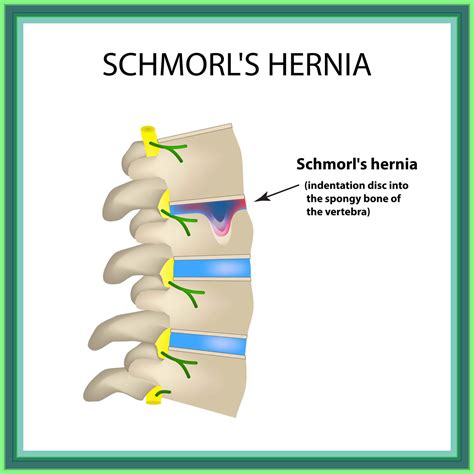 Herniaciones De Schmorl