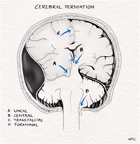 herniated muscle - Neurology - MedHelp