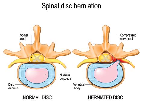 Herniation Of Muscle Through Its Ruptured Fascia Medical Term