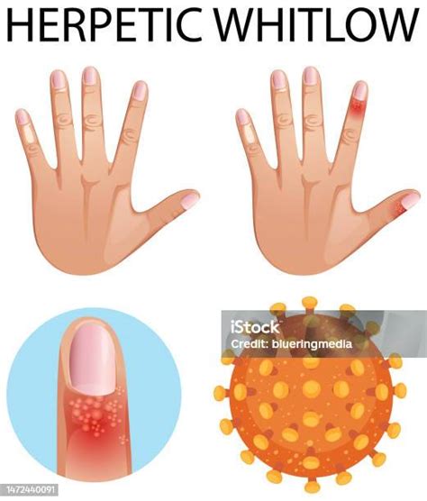 herpes fingrar