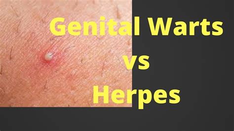 herpes genital