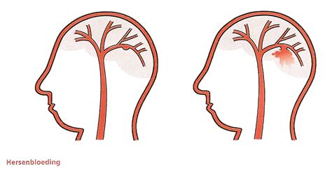hersenbloeding ernst