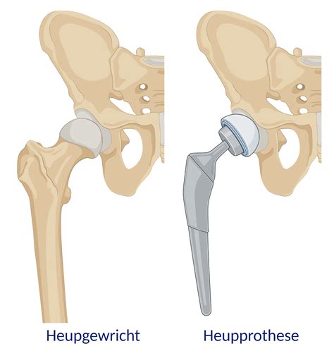 heupprothese vervangen