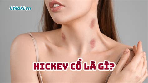 hickey cổ | Hickey l g Cch Hickey trn c