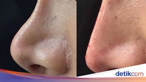 HIDUNG PESEK - Kenali Kepribadian Seseorang Melalui Bentuk Hidung, Kalau Pesek