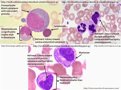 high absolute metamyelocytes in CBC? - HealingWell