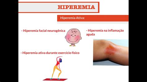 Hiperemia O Que é