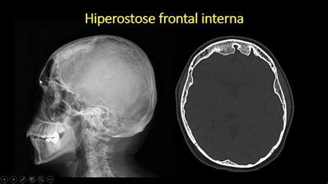 Hiperestose Frontal Interna