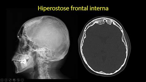 hiperostose frontal interna pdf
