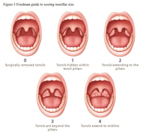 hipertrofi tonsil adalah