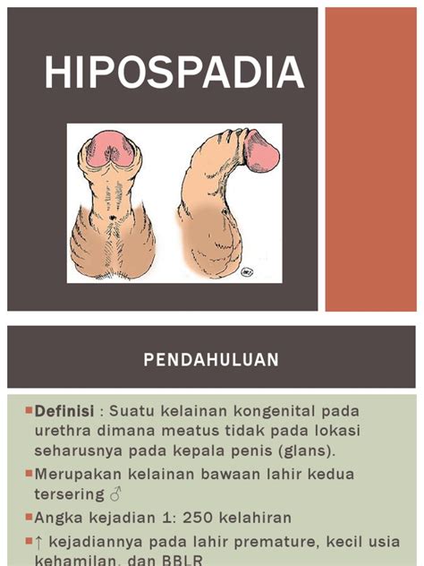 hipospadia adalah
