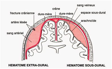 Hématome Extra Dural