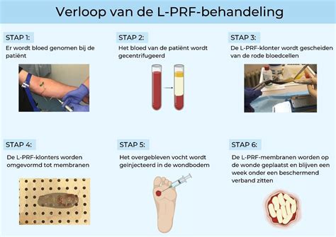 hoe lang werkt prf behandeling