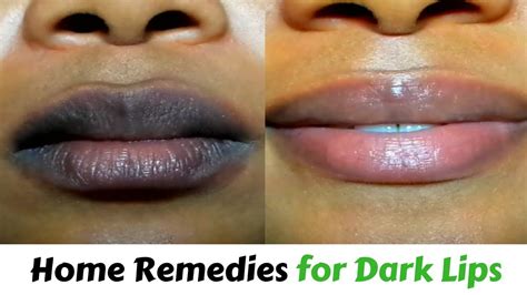 home remedies to remove blackness of lips without