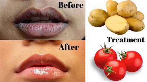home remedies to remove blackness of lips