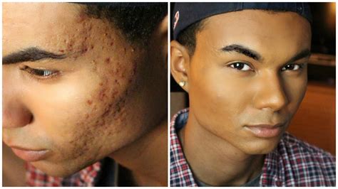 hot guys with acne scars