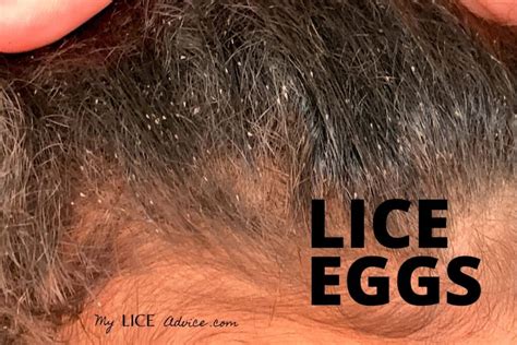 Agshowsnsw | How to check for head lice eggs