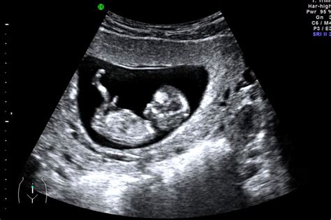 how accurate is dating scan at 12 weeks