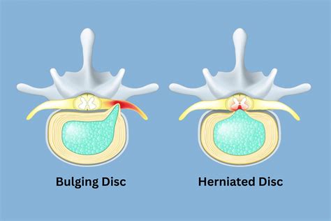 how bad is a bulging disc