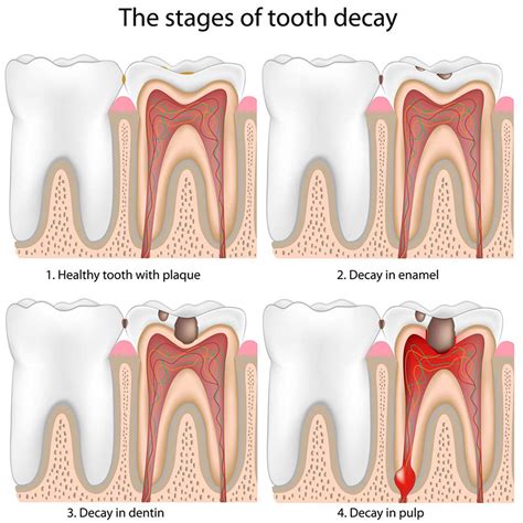 how bad is tooth decay
