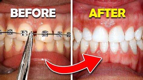 how braces are tightened