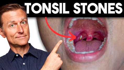 how can you get tonsil stones