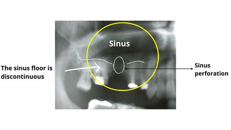 how common is sinus perforation after tooth extraction