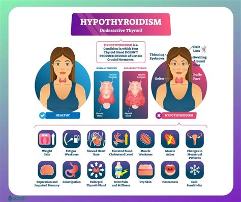 how common is underactive thyroid